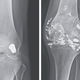 Two side-by-side x-rays of the man’s knee and the bullet, 14 years apart.